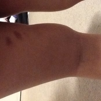 Lotsa Tots Childcare Services - BRUISES ON MY DAUGHTER'S LEG FROM THE IRRESPONSIBLE PEOPLE AT THE DAYCARE!!!!!!!!!! - Child Care & Day Care Near Me - Red Deer, Alberta Lotsa Tots Childcare Services - BRUISES ON MY DAUGHTER'S LEG FROM THE IRRESPONSIBLE PEOPLE AT THE DAYCARE!!!!!!!!!! - Child Care & Day Care Near Me - Red Deer, Alberta