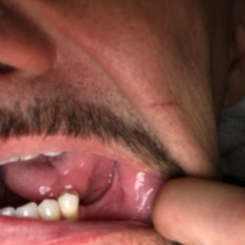 Quarry Creek Dental Group - No more molars and it cost me $3000 !! - General Dentistry Near Me - Oceanside, California Quarry Creek Dental Group - No more molars and it cost me $3000 !! - General Dentistry Near Me - Oceanside, California