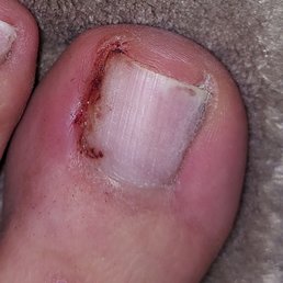 I stopped the Pedi here. The left side of my nail bed is exposed on the right u can tell where she stabbed me under the nail w/her tool I stopped the Pedi here. The left side of my nail bed is exposed on the right u can tell where she stabbed me under the nail w/her tool