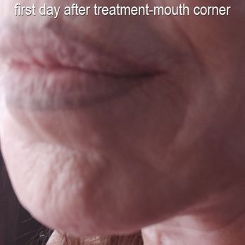 Revive Aesthetics - The puckering not improved and a bit more distorted - Medical Spas Near Me - Fairbanks, Alaska