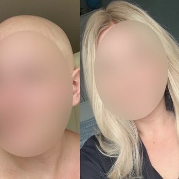 Kaelyss - Hair Loss Centers Near Me - Chicago, Illinois Kaelyss - Hair Loss Centers Near Me - Chicago, Illinois