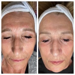Clarity By Hannah Brie - Results of two Procell microchanneling treatments.