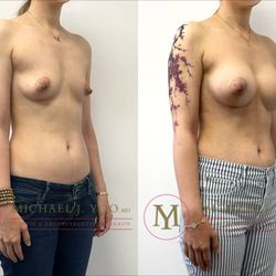 Michael J Yoo, MD - Breast Augmentation by Dr. Michael J. Yoo, MD - Double Board Certified Plastic Surgeon