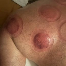 Fire cupping, old school Chinese therapy. Great if you're suffering an intense or long lasting pain. Fire cupping, old school Chinese therapy. Great if you're suffering an intense or long lasting pain.