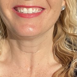 Mission Dental Implant Center: Al Manesh, DMD - Results the day of my 1st cleaning appointment.