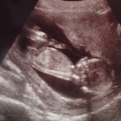 Revere Health Womens Center - You get two ultrasounds. The 1st is a complementary gender check @ 15-18 weeks. The 2nd is the full anatomy scan @ 20 weeks