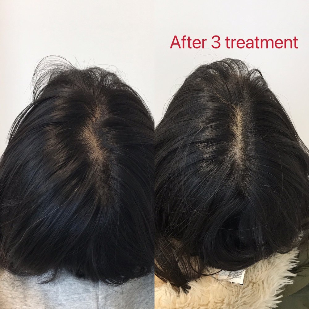 Solve Clinics - 3 month after my treatment you can see the middle part become more dense - Hair Loss Centers Near Me - Skokie, Illinois Solve Clinics - 3 month after my treatment you can see the middle part become more dense - Hair Loss Centers Near Me - Skokie, Illinois