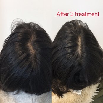 Solve Clinics - 3 month after my treatment you can see the middle part become more dense - Hair Loss Centers Near Me - Skokie, Illinois