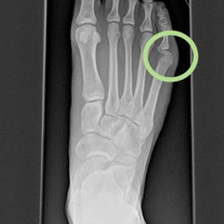 Orange County Podiatry - Tailor's Bunion
