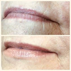 Oasis Medaesthetics - Before & After filler to lip lines.