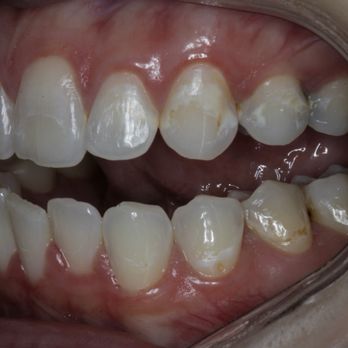 Serene Oaks Dental - Before photo! - General Dentistry Near Me - North Oaks, Minnesota Serene Oaks Dental - Before photo! - General Dentistry Near Me - North Oaks, Minnesota