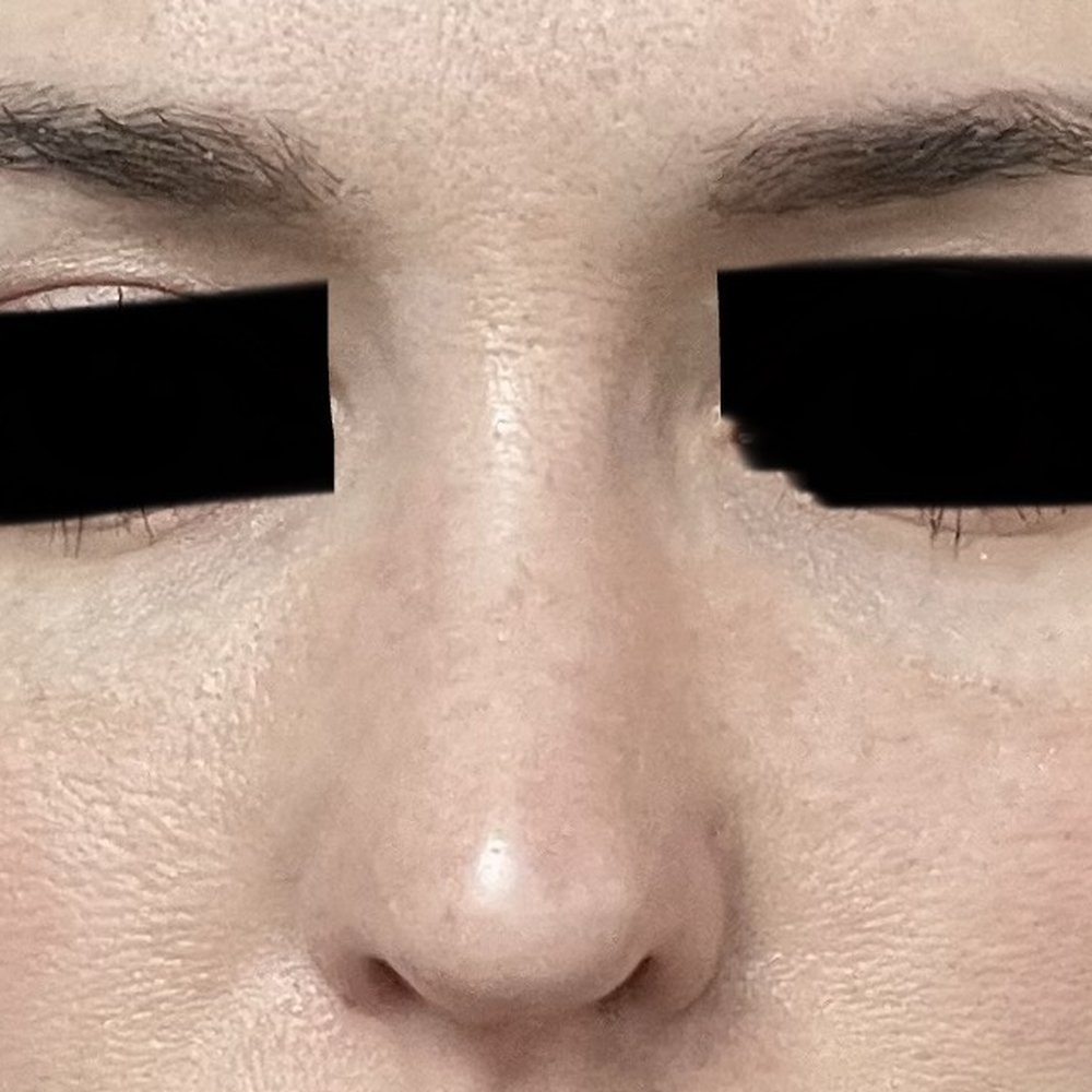 Bitner Facial Plastic Surgery - 5 weeks post op third rhinoplasty (first time with Dr. Bitner) - Cosmetic Surgeons Near Me - Layton, Utah Bitner Facial Plastic Surgery - 5 weeks post op third rhinoplasty (first time with Dr. Bitner) - Cosmetic Surgeons Near Me - Layton, Utah