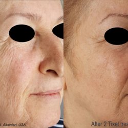 Skintopia - Tixel treatment for face wrinkles and crows feet