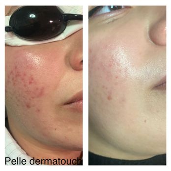 Pelle Derma Touch - Get rid of Acne and Acne scars - Skin Care Near Me - Vancouver, British Columbia Pelle Derma Touch - Get rid of Acne and Acne scars - Skin Care Near Me - Vancouver, British Columbia