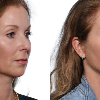 Jonathan Zelken, MD - Facetite - Cosmetic Surgeons Near Me - Newport Beach, California Jonathan Zelken, MD - Facetite - Cosmetic Surgeons Near Me - Newport Beach, California