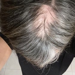 Transformed Aesthetic and Wellness Center - My head after two cycles of Biote. My hair has always been super thick, horrifying....