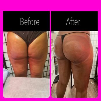 Jadore Sarah Beauty Center - Noninvasive butt enhancement #2 sessions - Body Contouring Near Me - Brooklyn, New York Jadore Sarah Beauty Center - Noninvasive butt enhancement #2 sessions - Body Contouring Near Me - Brooklyn, New York