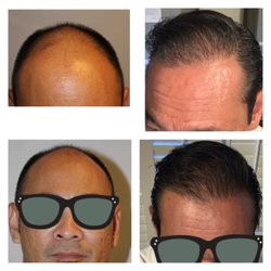 Hair Centers - 1800 grafts. 6 years apart