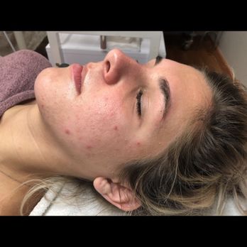 Skin Studio AZ - Before 1st Session - Skin Care Near Me - Scottsdale, Arizona Skin Studio AZ - Before 1st Session - Skin Care Near Me - Scottsdale, Arizona