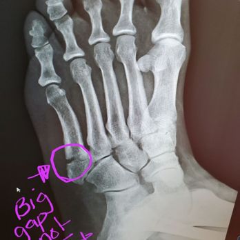 Raissi Abdi, MD - Fracture before surgery after 2 months attempting to heal a left foot Jones fracture. - Orthopedists Near Me - Las Vegas, Nevada Raissi Abdi, MD - Fracture before surgery after 2 months attempting to heal a left foot Jones fracture. - Orthopedists Near Me - Las Vegas, Nevada