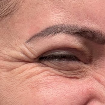 MD Esthetics Virginia Beach - Crows feet still very visible - Weight Loss Centers Near Me - Virginia Beach, Virginia MD Esthetics Virginia Beach - Crows feet still very visible - Weight Loss Centers Near Me - Virginia Beach, Virginia