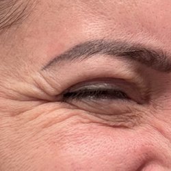MD Esthetics Virginia Beach - Crows feet still very visible