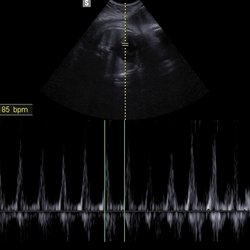 Home Baby Reveal - 2D - Baby's Heartrate