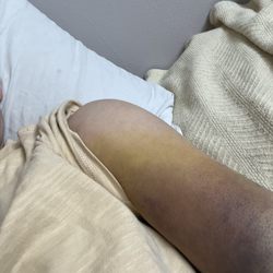 Virtua Our Lady of Lourdes Hospital - My hurt arm, which this CRAPPY EMERGENCY ROOM DIDN'T DO MUCH FOR!!!!