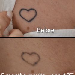 5 months results after only one ART treatment