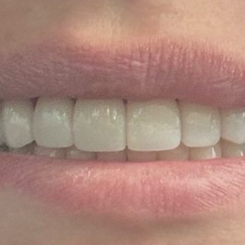 Sincere Smiles - After 8 veneers - General Dentistry Near Me - San Jose, California Sincere Smiles - After 8 veneers - General Dentistry Near Me - San Jose, California
