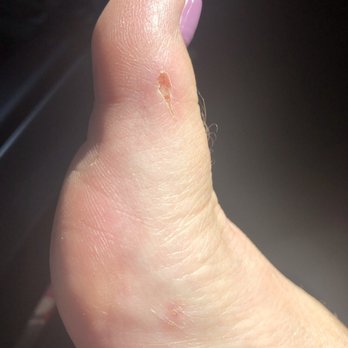 Pearl Nails and Spa - The day after my pedicure. It not only hurt but the callous remover stung so bad:( - Nail Salons Near Me - Long Beach, California