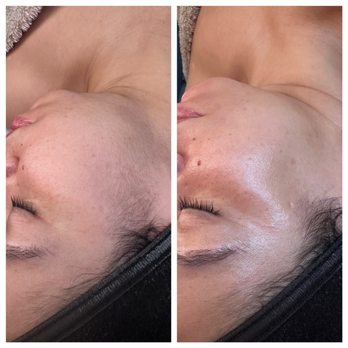 Rejuv Me Care - Before and after Dermaplaning Facial - Skin Care Near Me Rejuv Me Care - Before and after Dermaplaning Facial - Skin Care Near Me