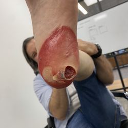 Eyre Dermatology Clinic - Huge hole Dr Eyre expertly dug out of my foot. Highly recommend.