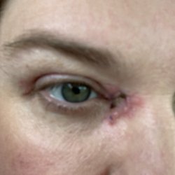 The wound shrinking and graph looking great.