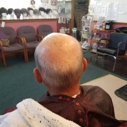 Hair replacement before