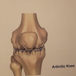 All Star Physical Therapy - My knee before All Star