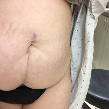 Sono Bello - Before - Cosmetic Surgeons Near Me - San Antonio, Texas Sono Bello - Before - Cosmetic Surgeons Near Me - San Antonio, Texas