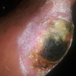Blessing Hospital Wound Healing & Hyperbaric Center - This is what happened to my Dad's foot following toe amputation! BEWARE!!!!