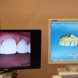 Peter Do DDS - Cerec  One Visit Crown - Patient received permanent crown on the same visit.  No more temporary crown.