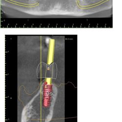 La Jolla Dental Implants & Periodontics - One of the world top specialist in 3D guided dental implant placement.
