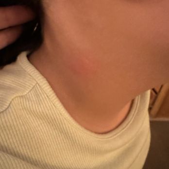 Great Wolf Lodge - Bed bugs - Resorts Near Me - Mason, Ohio Great Wolf Lodge - Bed bugs - Resorts Near Me - Mason, Ohio