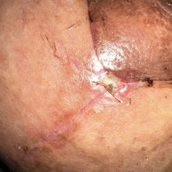 Blinski Plastic Surgery - Non-dissolvable sutures tearing my alveolar open.