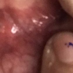 CANKER SORE