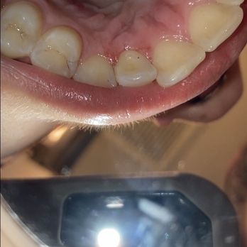 Advantage Dental+ - It's hard to tell from the odd angle but you can see how he tore up my gum around tooth - Orthodontists Near Me - Portland, Oregon