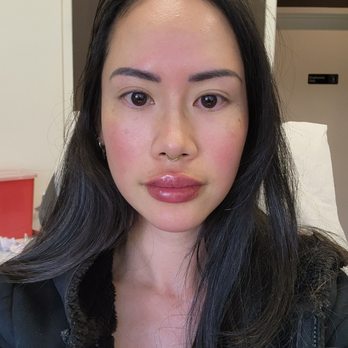 17 MedSpa - Lip filler done! Sooo pretty I'm obsessed! - Medical Spas Near Me - Cupertino, California 17 MedSpa - Lip filler done! Sooo pretty I'm obsessed! - Medical Spas Near Me - Cupertino, California