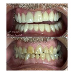 Denna Dental - Full Mouth rehabilitation and cosmetic makeover!