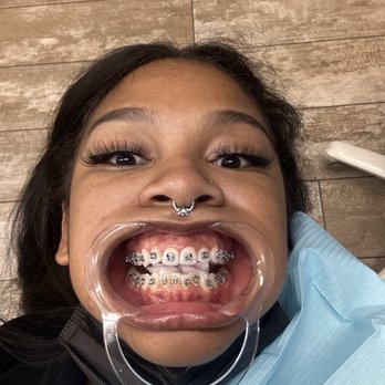 Happy Braces - Before - Orthodontists Near Me - Lakewood, California Happy Braces - Before - Orthodontists Near Me - Lakewood, California