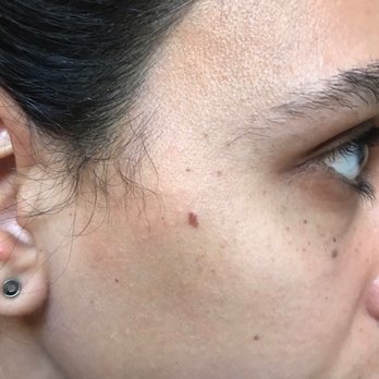 The Roxbury Institute - Unnecessary burn scar - Dermatologists Near Me - Beverly Hills, California The Roxbury Institute - Unnecessary burn scar - Dermatologists Near Me - Beverly Hills, California