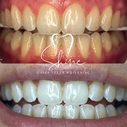 Shine Laser Teeth Whitening Spa