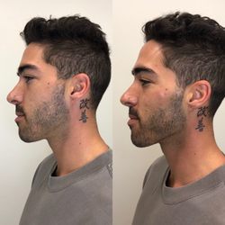 Coastal Medical Aesthetics - Before & After 4 syringes of Juvederm Volux for the jawline and 2 syringes of Juvederm Voluma for the cheeks